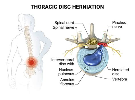 Thoracic Disc Herniation NJ & NYC