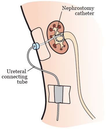 Información sobre el catéter de nefrostomía | Memorial Sloan Kettering ...