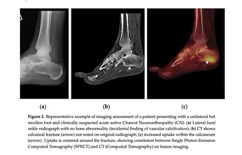 SPECT-CT in the early diagnosis of Charcot arthropathy - DF Blog