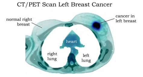 Breast PET Scans