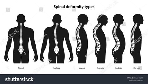 1,827 Spinal Deformities Images, Stock Photos & Vectors | Shutterstock