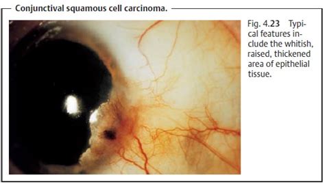 Conjunctiva Tumors