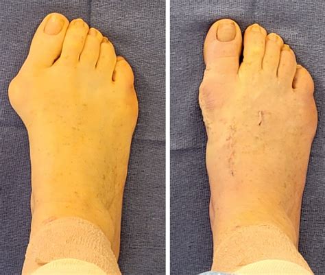 How to Reduce Scarring After Bunion Surgery — Dr. Paul Steinke ...