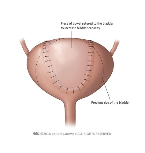 Urinary incontinence - Patient Information