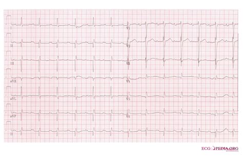 Left atrial enlargement electrocardiogram - wikidoc