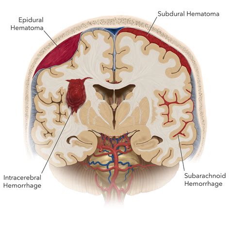 Subdural Hematoma Vs Subarachnoid Hemorrhage