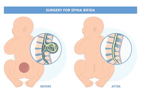 Spina Bifida in Babies - Symptoms, Diagnosis And Treatment - Being The ...