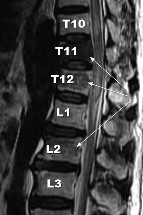 Sagittal Fracture