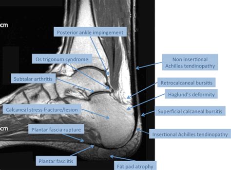 What Is Superficial Calcaneal Bursitis? | LFAC