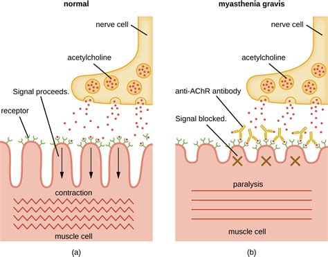 Myasthenia gravis, Autoimmune disorders, By OpenStax (Page 4/7) | Jobilize