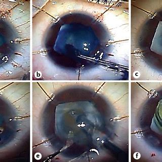 Left eye before surgery. Band keratopathy, posterior synechiae and ...