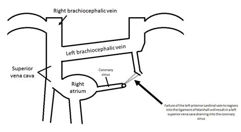 View of Persistent left-sided superior vena cava | The Southwest ...