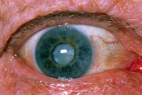 Cataracts Causes, Signs, Symptoms, Surgery, Recovery & Complications