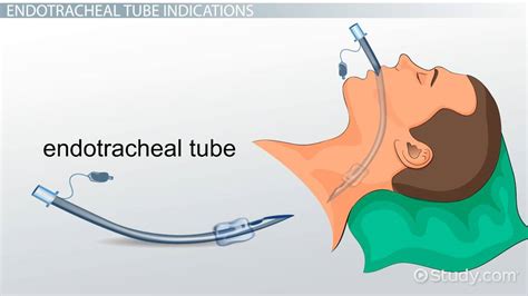 Tracheostomy Tube Insertion