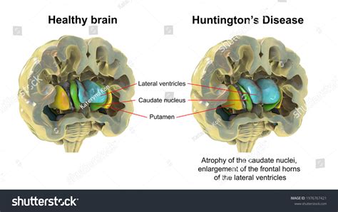 Dorsal Striatum Lateral Ventricles Healthy Brain Stock Illustration ...