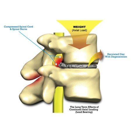 Facet Hypertrophy Treatment | Without Surgery Or Injections