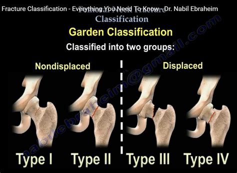 Femoral Neck fracture classification — OrthopaedicPrinciples.com