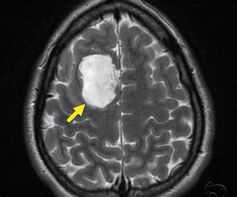 Asymptomatic Intracranial Epidermoid Cyst | Figure 1