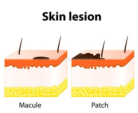 Skin Lesions Type Macule Papule