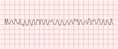 Ventricular Fibrillation: Causes & Treatment [ACLS Algorithm]