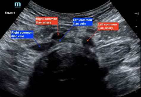 A Case Report of May-Thurner Syndrome Identified on Abdominal ...