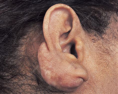 Keloid scarring after ear piercing - Stock Image - C046/1711 - Science ...