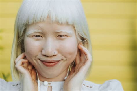 Albinism: Causes, Types, and Symptoms - Cure Chiropractic