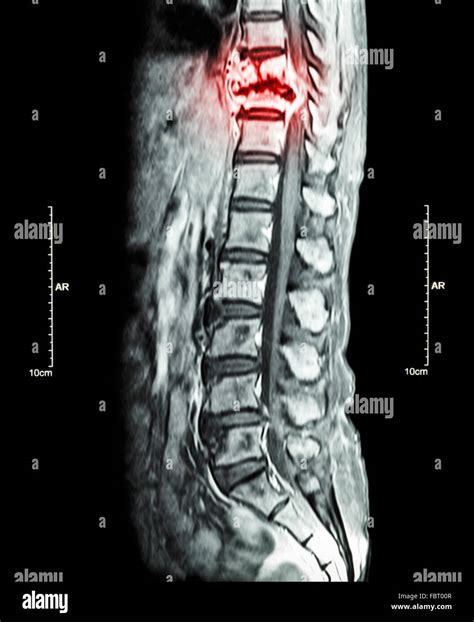 Spine metastasis ( cancer spread to thoracic spine ) ( MRI of thoracic ...