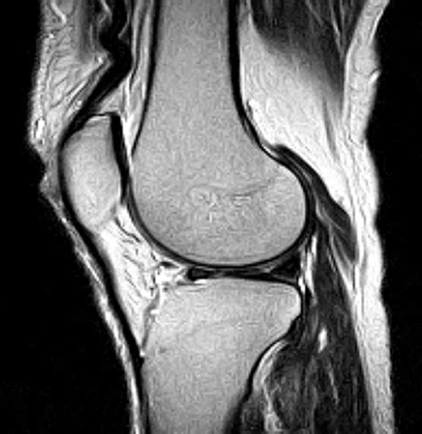 Knee MRI scan | Medserena Open MRI