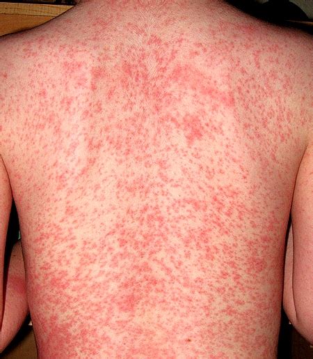 Heat Rash - Pictures, Treatment, Causes, Types, Symptoms, Prevention ...