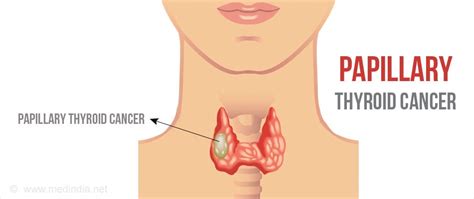 Side Effects Of Papillary Thyroid Cancer - CancerWalls