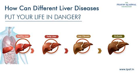 How Can Different Liver Diseases Put Your Life in Danger? - TPAF