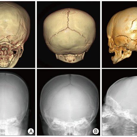 Simple Skull Fracture