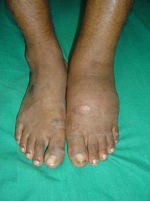 Neuropathic arthropathy - Wikipedia