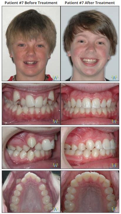 Braces Before & Afters | Walton Orthodontics