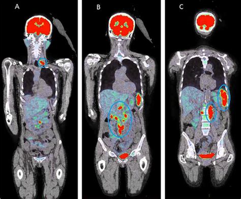 An overview about PET CT scans in a nutshell – PrzeSpider