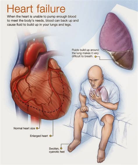 Heart Failure Causes, Symptoms And Signs - Health And Medical Information