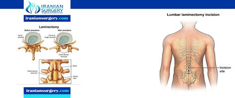 laminectomy complications | lumbar laminectomy complications