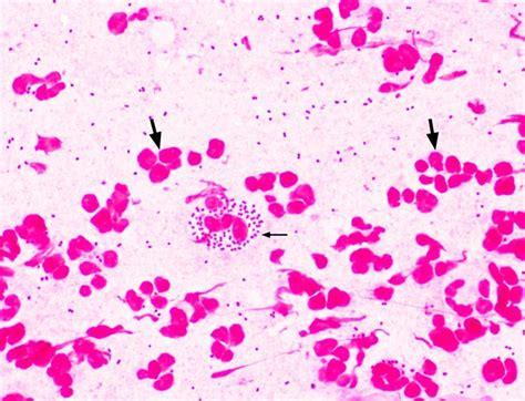 Neisseria gonorrhoeae present in a Gram stain of a patient with ...