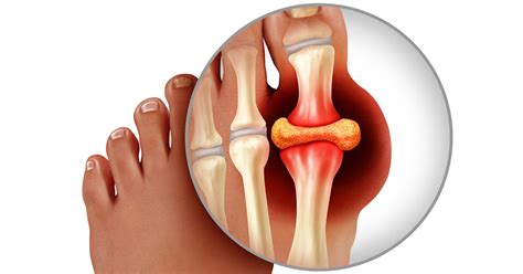 Gout/Gouty Arthritis In Depth: Risk Factors, Treatment | HSS