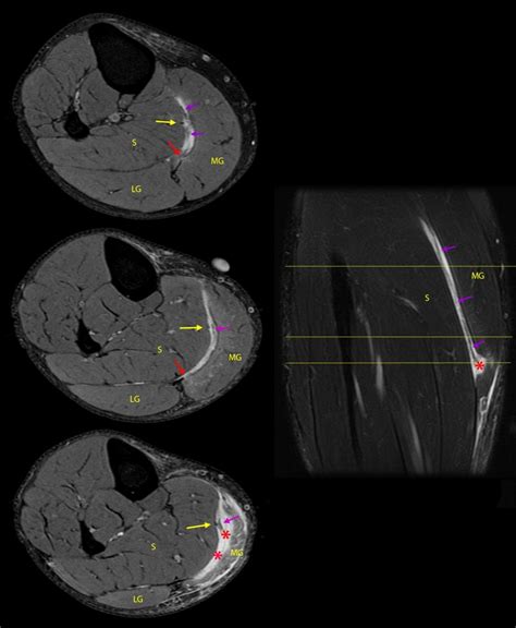 Not the Plantaris – Keys to Better Diagnosis of Calf Strain Injuries ...