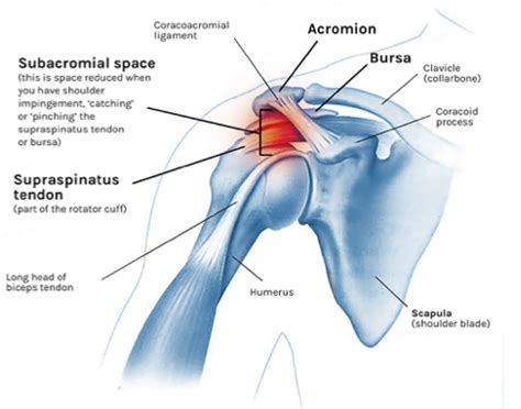 The Effect of Posture on Shoulder Pain | From a Top Physical Therapist ...