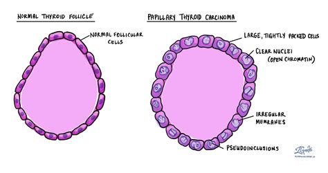 Papillært skjoldbruskkirtelcarcinom | MyPathologyReport.ca