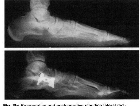 Talipes Calcaneovalgus | Semantic Scholar