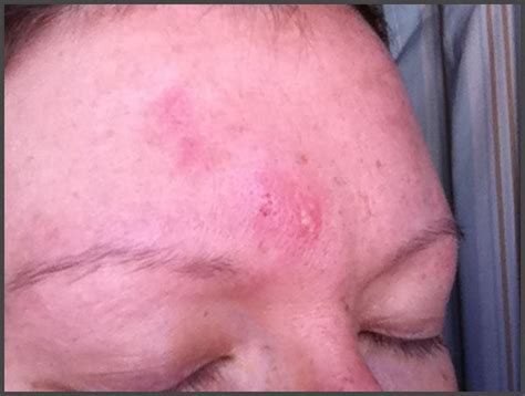 Shingles pictures face | Shingles Expert