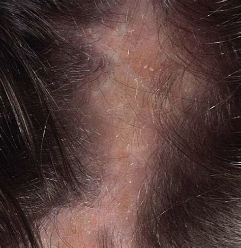 Scalp Infections Causes Symptoms Treatments And Pictures | Free Hot ...