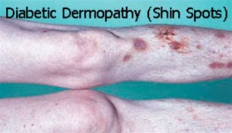 Diabetic Dermopathy - Pictures, Diagnosis, Treatment - (Updated - 2018)