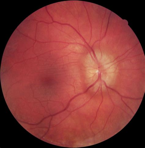 Differentiating True Optic Nerve Edema - Eyedolatry