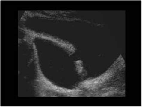 Urinary Tract and male reproductive system | 2.2 Bladder : Case 2.2.3 ...