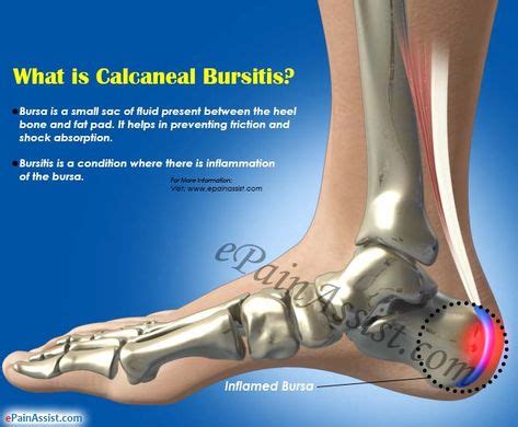 What is Calcaneal Bursitis | Bursitis, Bursitis treatment, Heel bursitis